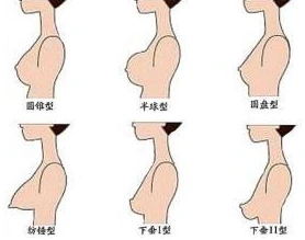 郑州芳艺整形医院陈涛乳房下垂矫正 让您挺胸做女人
