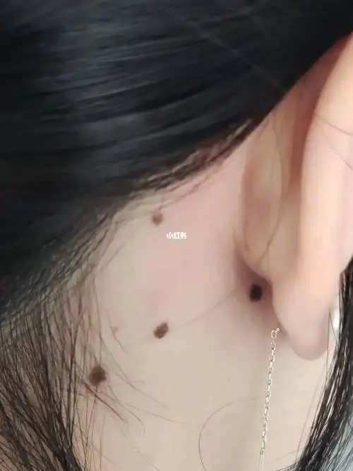 有没有一样的姐妹耳朵后面长痣