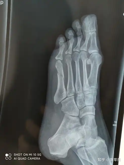 60天不放心还去拍了片子,骨折线已经模糊,但是错位的地方还是没有连接