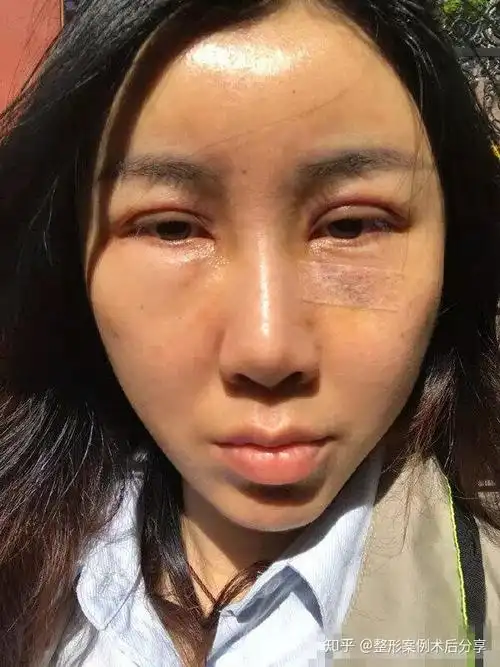 做双眼皮 脂肪填充1年多了,右边眼袋脂肪还是肿胀着,眼窝凹陷,眼皮