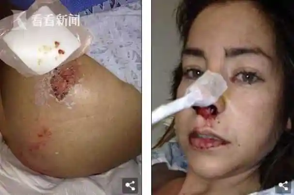 遭尿液腐蚀全身溃烂女模把伏特加当水喝长达6年