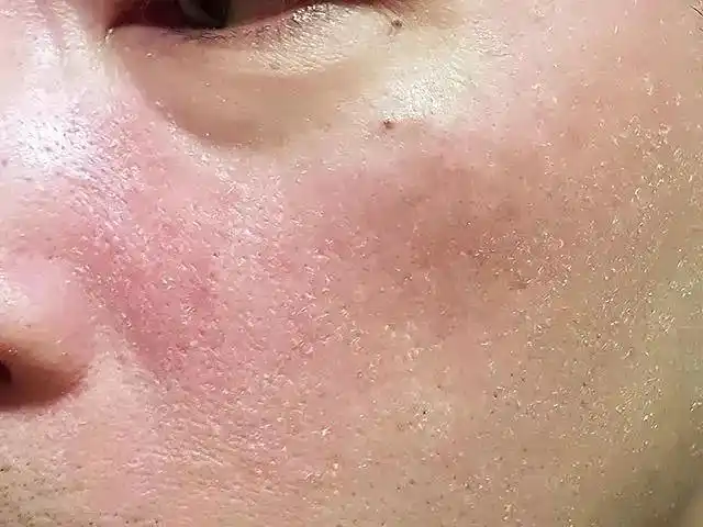 混油皮一到秋冬就爆干皮,皮肤水油不平衡到底要怎么解决?