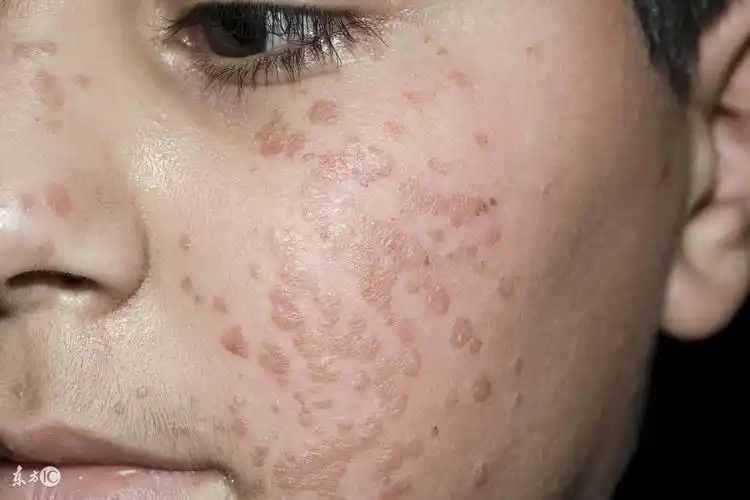 治扁平疣快速有效的治疗扁平疣有什么特效药吗