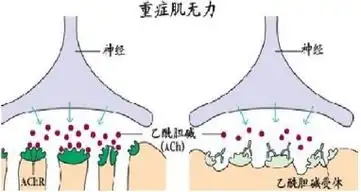 【健康科普】走进罕见病之一——重症肌无力