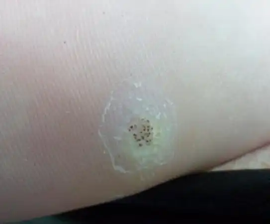 的请皮肤科老师看看这个"鸡眼"上面黑色的像芝麻一样的东东西是什么?