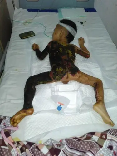 两岁半的孩子被烫伤