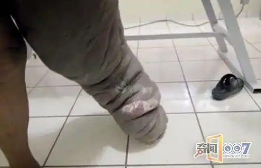 他只是被蚊子咬了一口结果左腿肿成大象腿