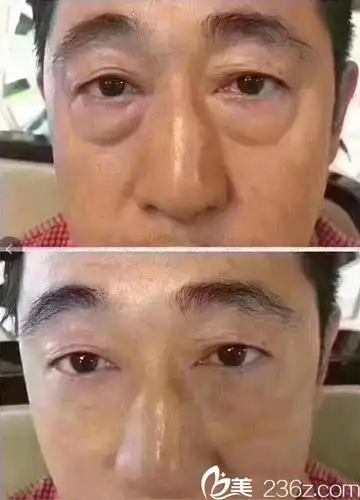 双眼皮 开眼角4999元,鼻综合4800元