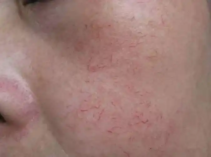 红血丝该怎么护理?