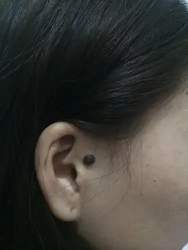 小时候五六岁开始长得,麻烦懂的这个解释一下,谢谢.