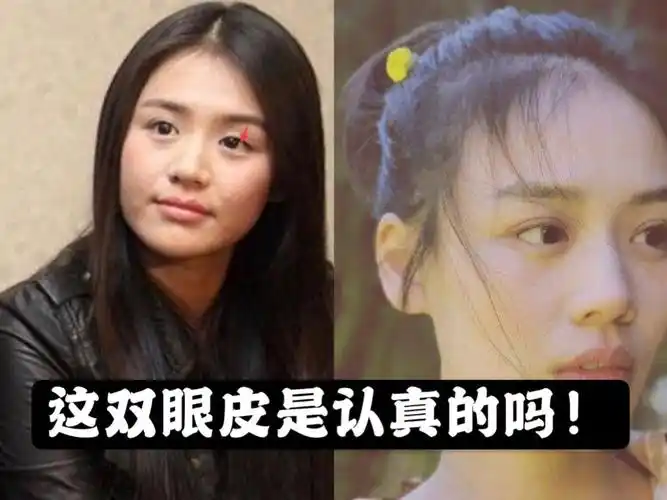 79马思纯的双眼皮究竟是找谁做的双眼皮肉条这么明显