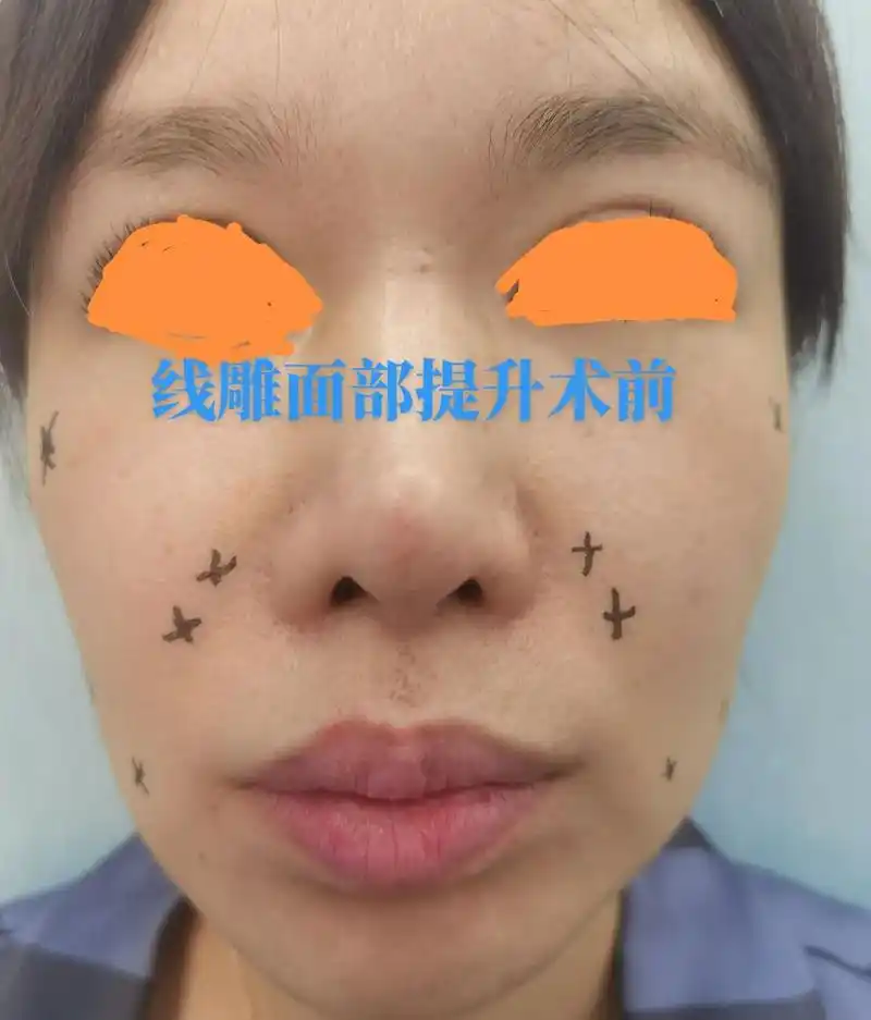 线雕面部提升术 - 抖音