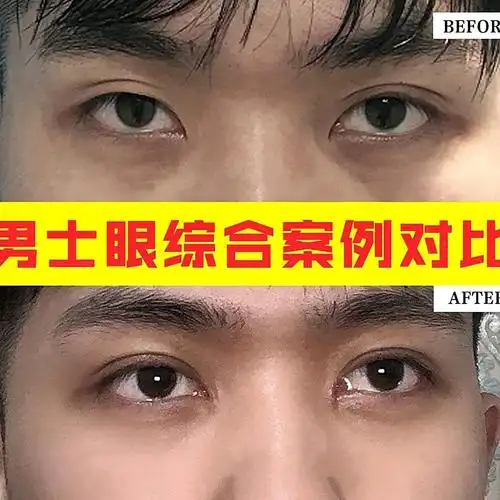 91男士眼部多项案例对比男士做双眼皮手术不需过于追求眼_圈子-新氧
