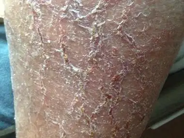 皲裂性湿疹小腿皮肤干燥脱屑裂口图.jpg