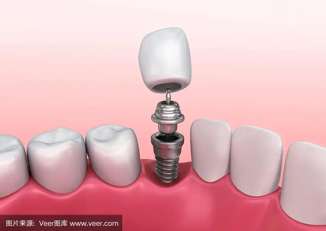 种植牙安装过程,医学精确3d插图白色风格