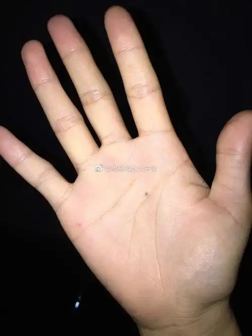 手掌有痣代表什么
