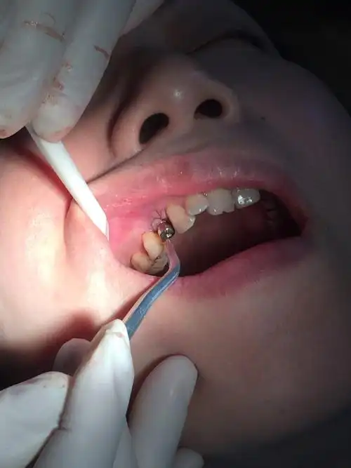 刘铭东口腔种植体修复案例