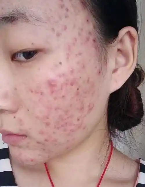 面部皮肤屏障受损怎么办?该如何修复屏障受损?