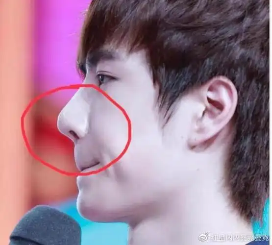 王一博鼻子透光了被质疑是鞠婧祎同款鼻子两人是同一个医生吗