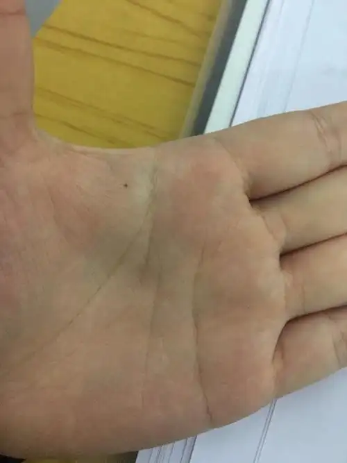 左手的手掌突然长了一颗这样的痣,想知道有什么问题吗?女生22岁.