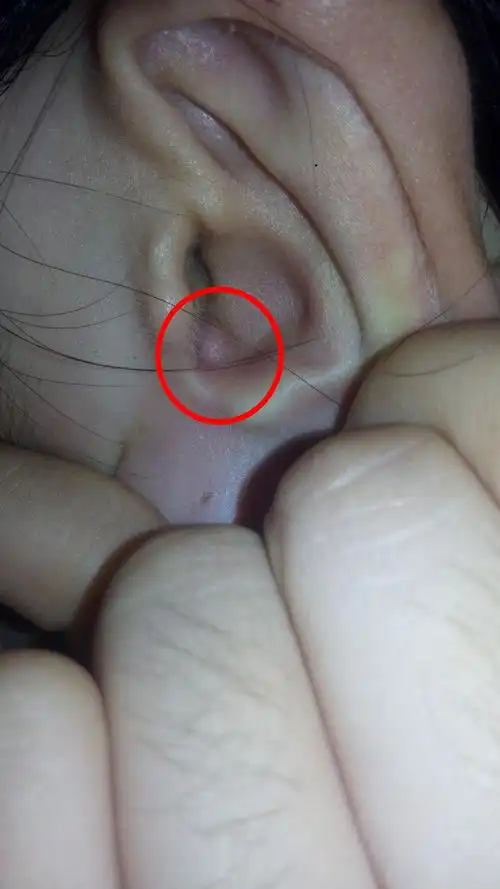 耳朵里长了一个软疙瘩,白色的,一碰就疼而且还有点痒