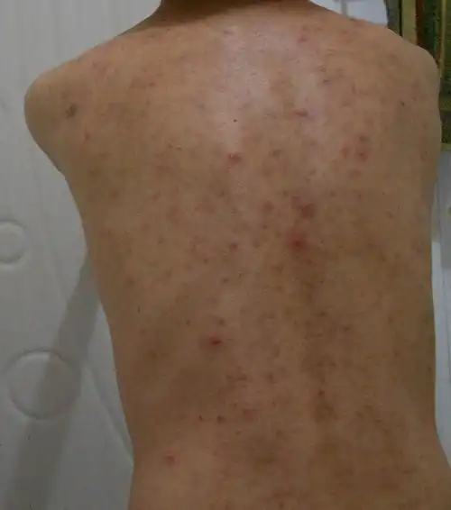 后背痤疮症状图片