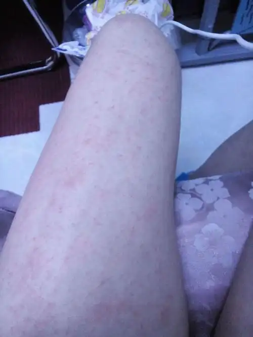 打完针后大概5个小时后全身起小红点,挠完