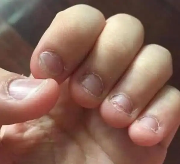 从小咬指甲的孩子长大后会变成什么样逃不掉这两种结局