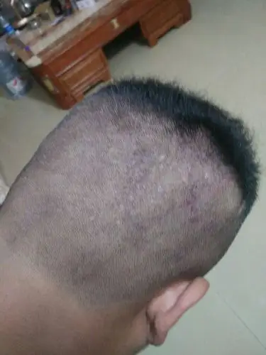 头皮为什么会这样 是头藓吗