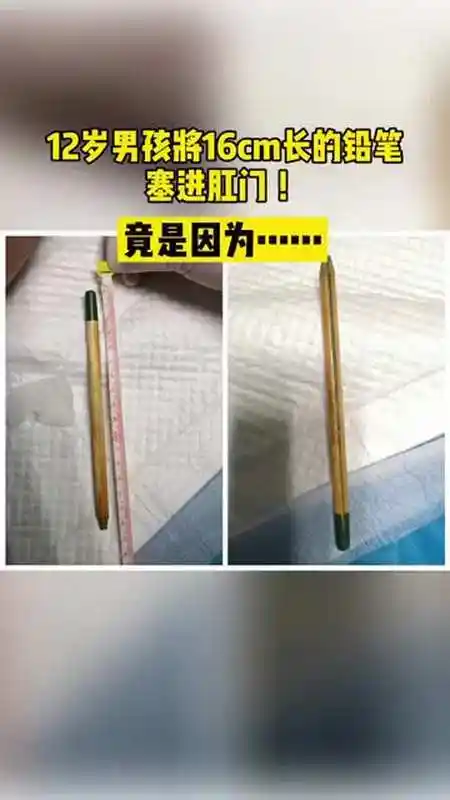 12岁男孩将16cm长的铅笔塞进肛门竟是因为