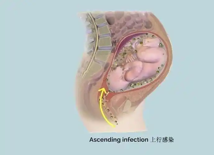 羊膜腔感染(iai,也称绒毛膜羊膜炎)指的是羊水,羊膜,胎盘,脐带和或