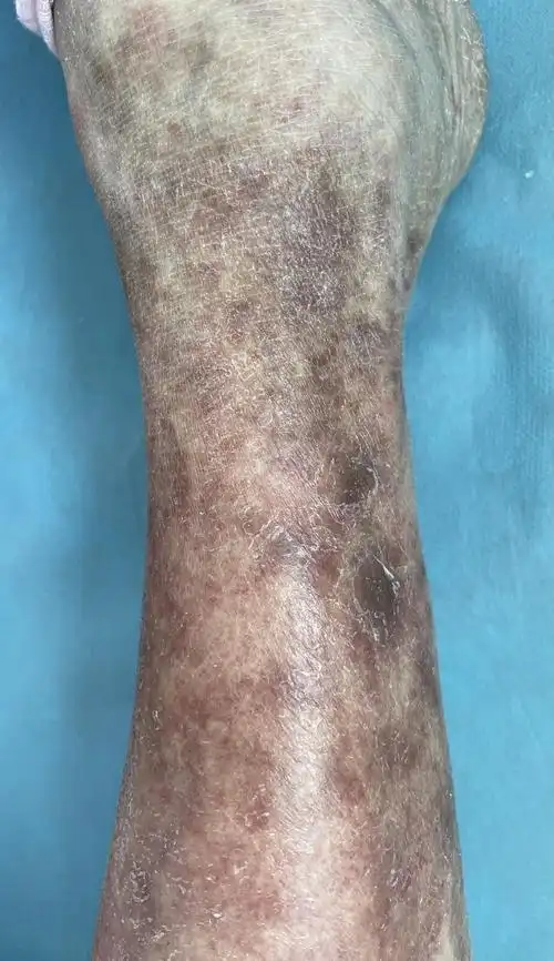 老人腿上的褐色斑为啥总是治不好呢?