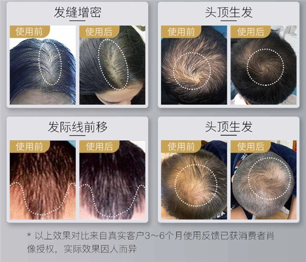 小米有品众筹激光生发帽:12周长出新发
