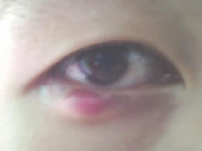 麦粒肿的治疗局部湿热敷有利于和血液循环,减轻疼痛,滴抗生素眼水和涂