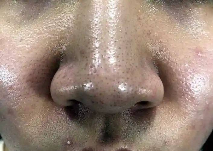 男生去角质用什么好