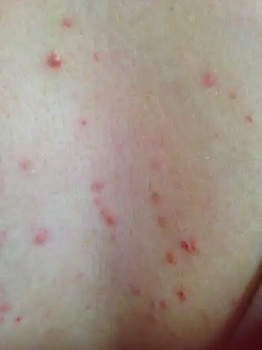 乳沟正中长了四颗红色点点,有点像痘痘,但又痛又痒,左边乳房也按压痛