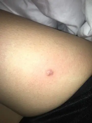 右腿上长的这个瘤有7年了,不痛不痒.偶尔阴雨天气会有点点痒痒的感