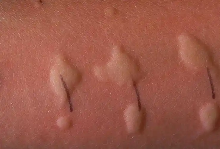 bmj丨有关过敏症,这几个误区你可能会遇到