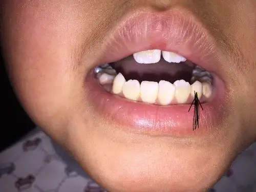 孩子今年8岁,下虎牙松动了,是要换牙么?这个牙应该几岁换?