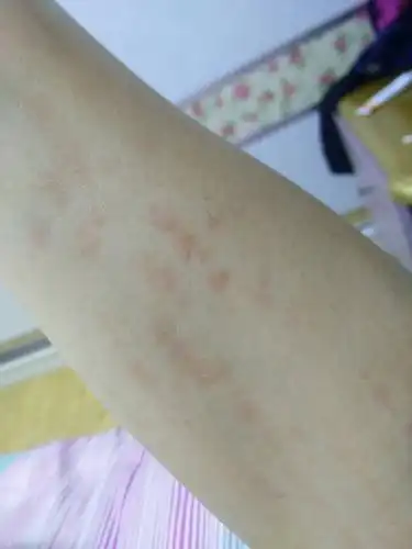 全身起红疹是成人sttill病吗?