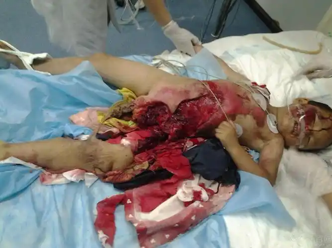 碾压伤 - 骨科专业讨论版 -丁香园论坛