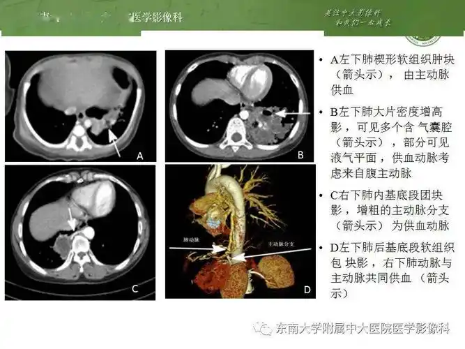 肺隔离症影像表现_郑孝飞