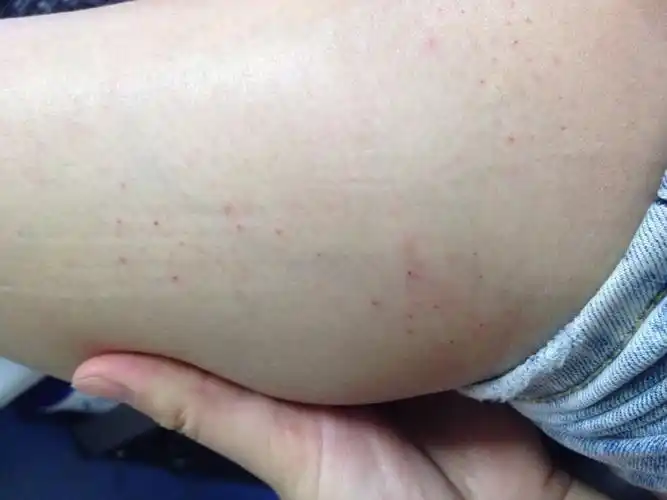 小腿上长了这些东西,是不是皮肤,病啊?