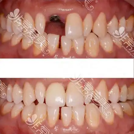 种植牙真人案例