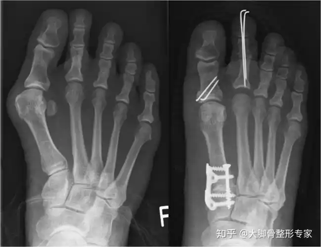 做完大脚骨手术后需要包扎多久一周还是一个月