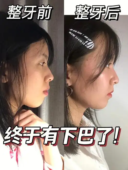 整牙700天75前后对比73点开有惊喜