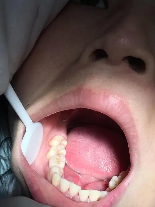 先天性下合第二双尖牙缺失