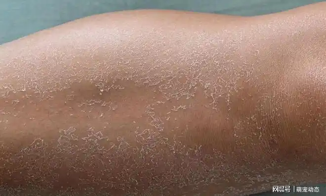 又烦又没办法冬天皮肤干燥脱屑这个难缠的问题你有吗