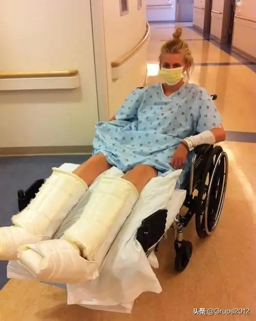 女模受卫生棉条感染致截肢换金腿踏舞台改变无法接受的事