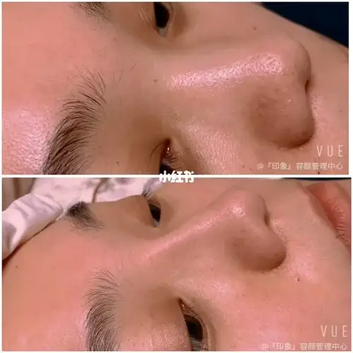 玻尿酸鼻子即刻对比90_玻尿酸_玻尿酸鼻子_美妆_医美整形